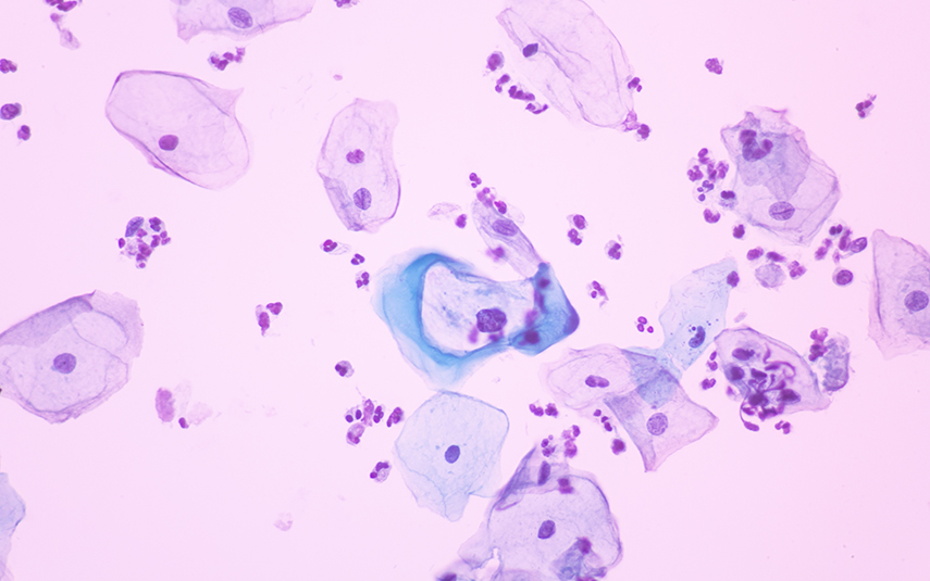 Οξυγενή Κονδυλώματα | DermaMedica