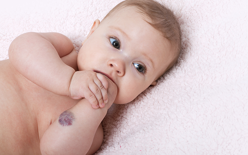 Αγγειακές Δυσπλασίες Παίδων | Παιδοδερματολογία – DermaMedica