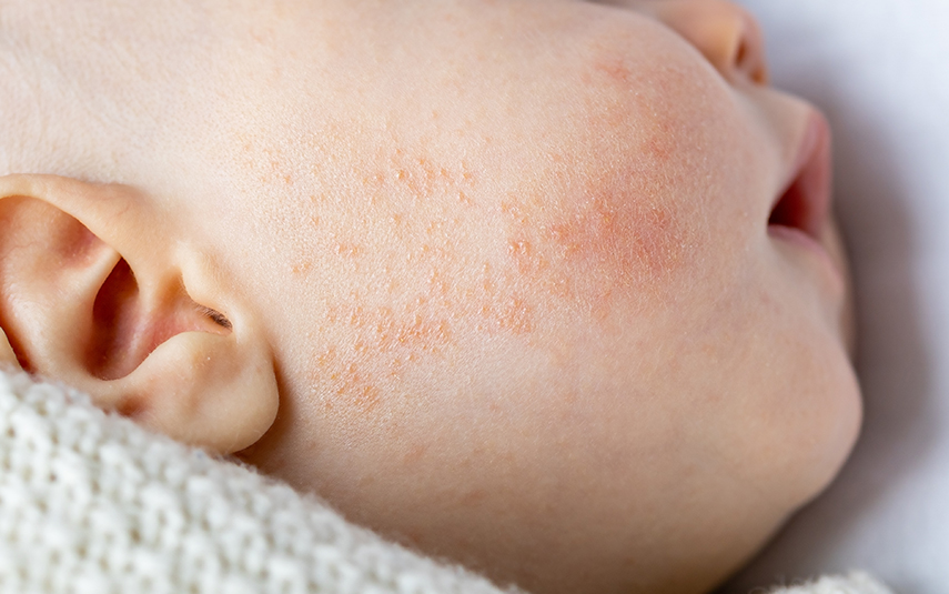 Ατοπική Δερματίτιδα σε Παιδιά | Συμπτώματα & Αντιμετώπιση – DermaMedica