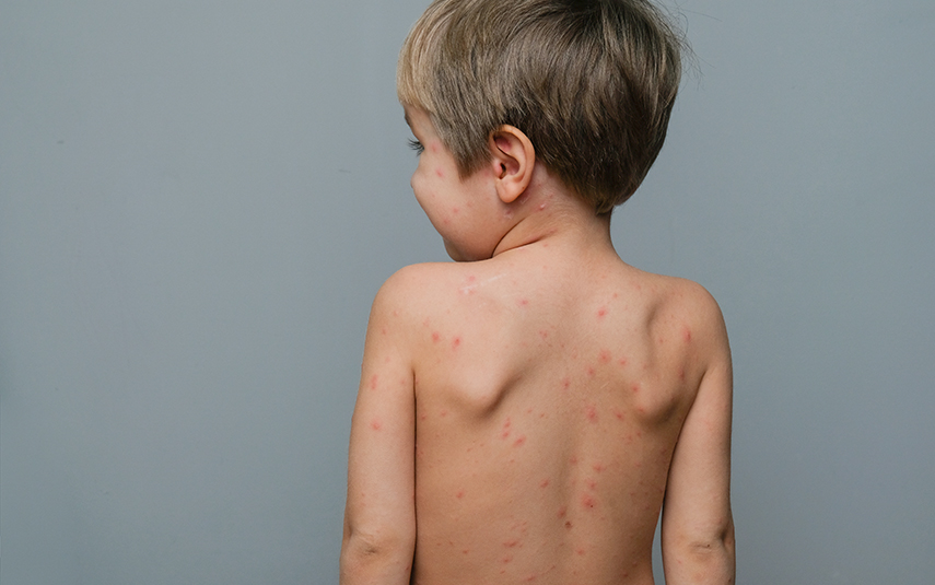 Μυκητιάσεις Παίδων | DermaMedica