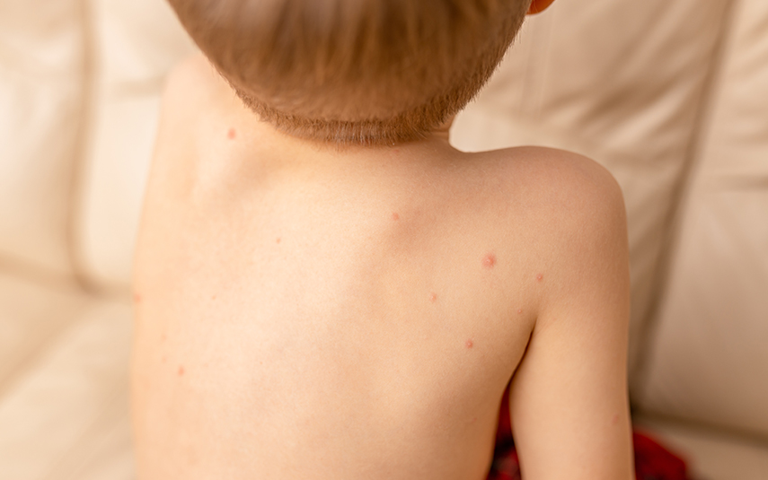 Μολυσματική Τέρμινθος σε Παιδιά | DermaMedica 