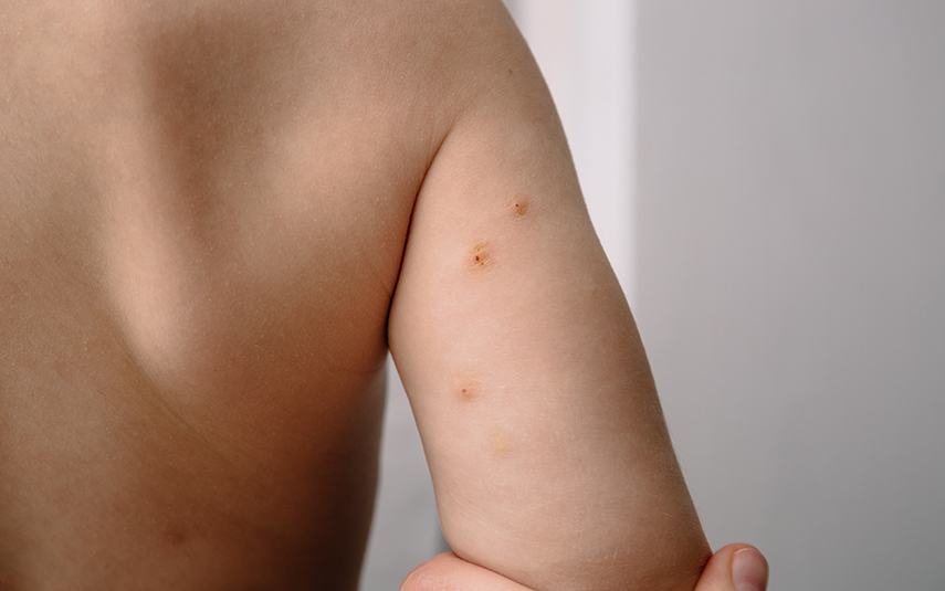 Θεραπεία Μολυσματικού Κηρίου για Παιδιά | DermaMedica