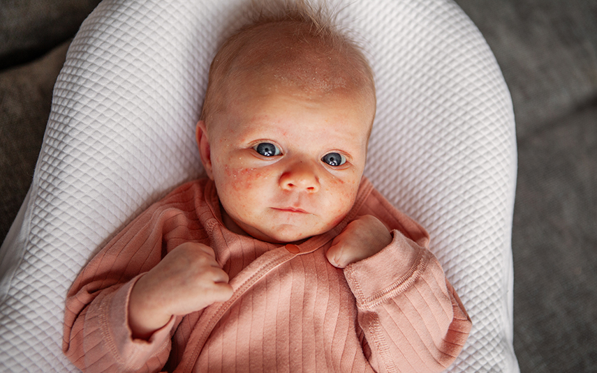 Νεογνική Κεφαλική Φλυκταίνωση (Νεογνική Ακμή) | Medica