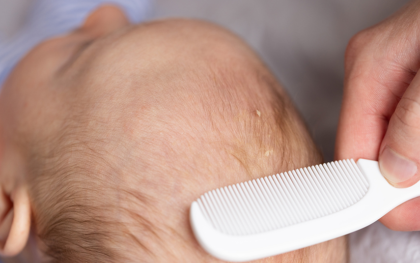 Νινίδα σε Βρέφη: Τι είναι & Πώς Αντιμετωπίζεται | DermaMedica