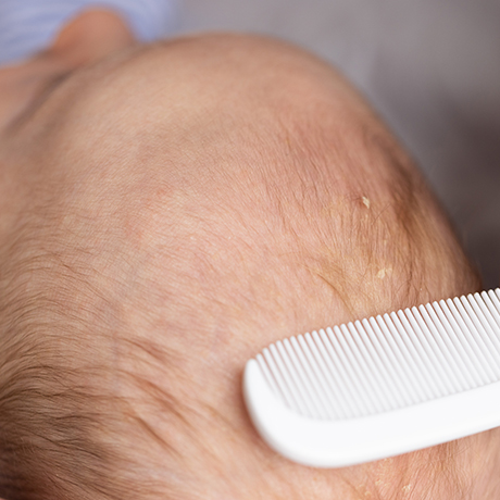 Νινίδα σε Βρέφη: Τι είναι & Πώς Αντιμετωπίζεται | DermaMedica