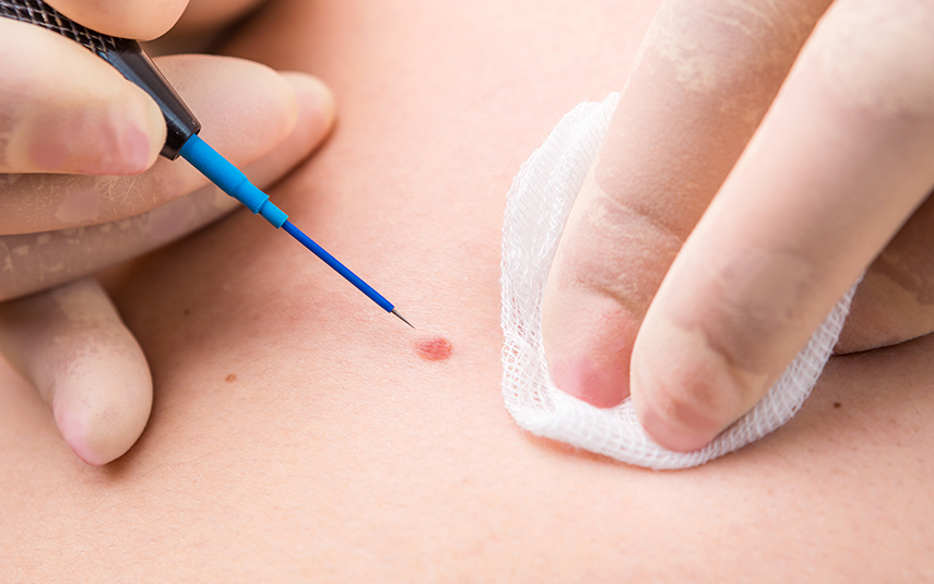 Ηλεκτροχειρουργική για Δερματικές Βλάβες – Τεχνική & Πλεονεκτήματα | DermaMedica