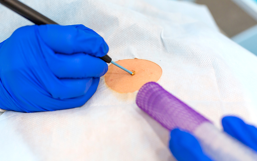 Χειρουργική Εξαίρεση Δερματικών Βλαβών – Καλοήθεις & Κακοήθεις | DermaMedica