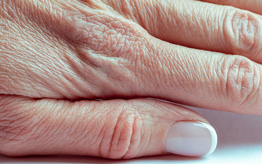 Ακτινικές Υπερκερατώσεις | Πρόληψη & Αντιμετώπιση | DermaMedica Αγ. Στέφανος