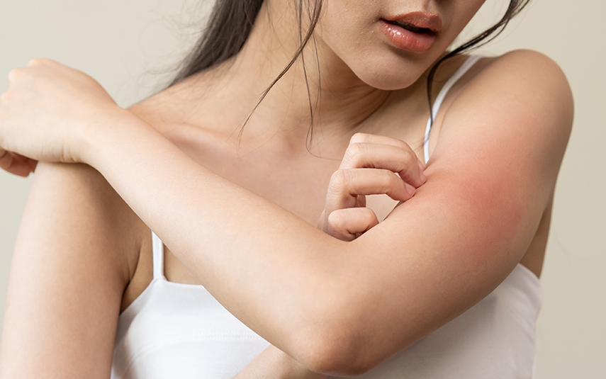 Έκζεμα & Δερματίτιδες – DermaMedica Άγιος Στέφανος