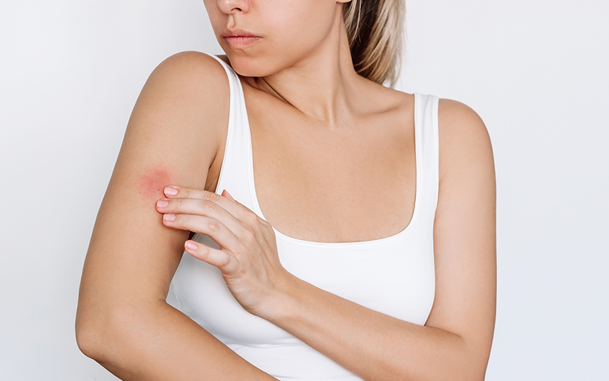 Κνίδωση: Ιδιοπαθής, Φυσική & Εξ Επαφής | Συμπτώματα & Αντιμετώπιση | DermaMedica Άγιος Στέφανος