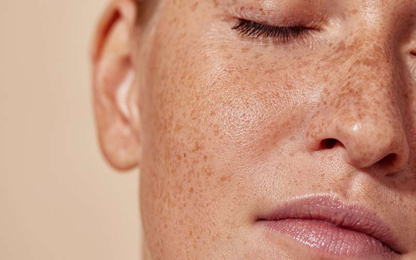 Μέλασμα (Πανάδες): Αντιμετώπιση & Θεραπεία | DermaMedica