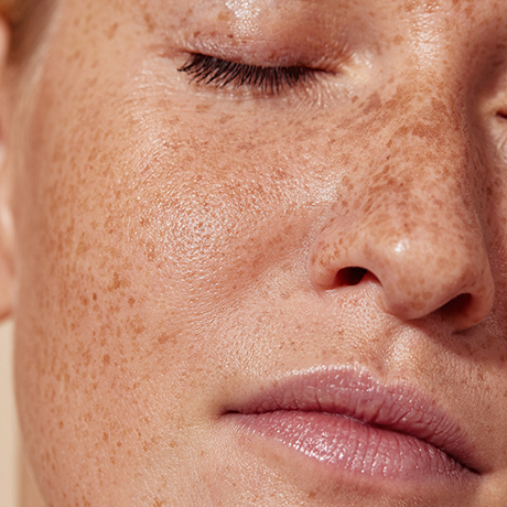 Μέλασμα (Πανάδες): Αντιμετώπιση & Θεραπεία | DermaMedica