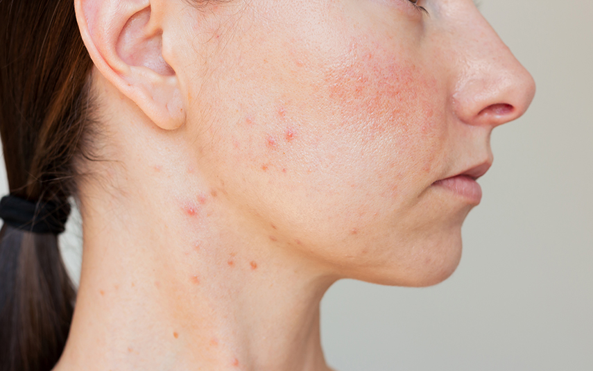 Ροδόχρους Νόσος: Συμπτώματα & Αντιμετώπιση | DermaMedica