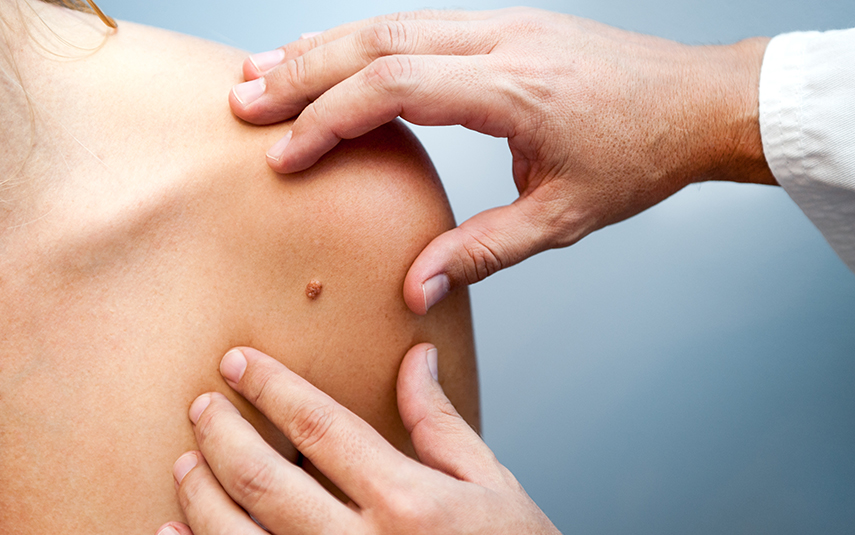 Σπίλοι: Επίκτητοι & Συγγενείς | Έλεγχος & Παρακολούθηση | DermaMedica