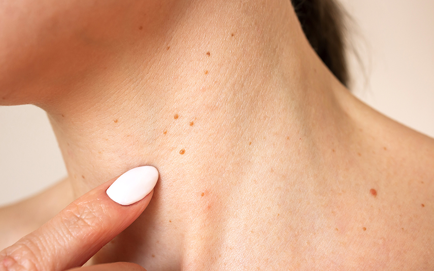 Θηλώματα (Ακροχόρδονες) | Αφαίρεση & Αντιμετώπιση | DermaMedica Άγιος Στέφανος