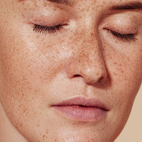 Μέλασμα (Πανάδες): Αντιμετώπιση & Θεραπεία | DermaMedica